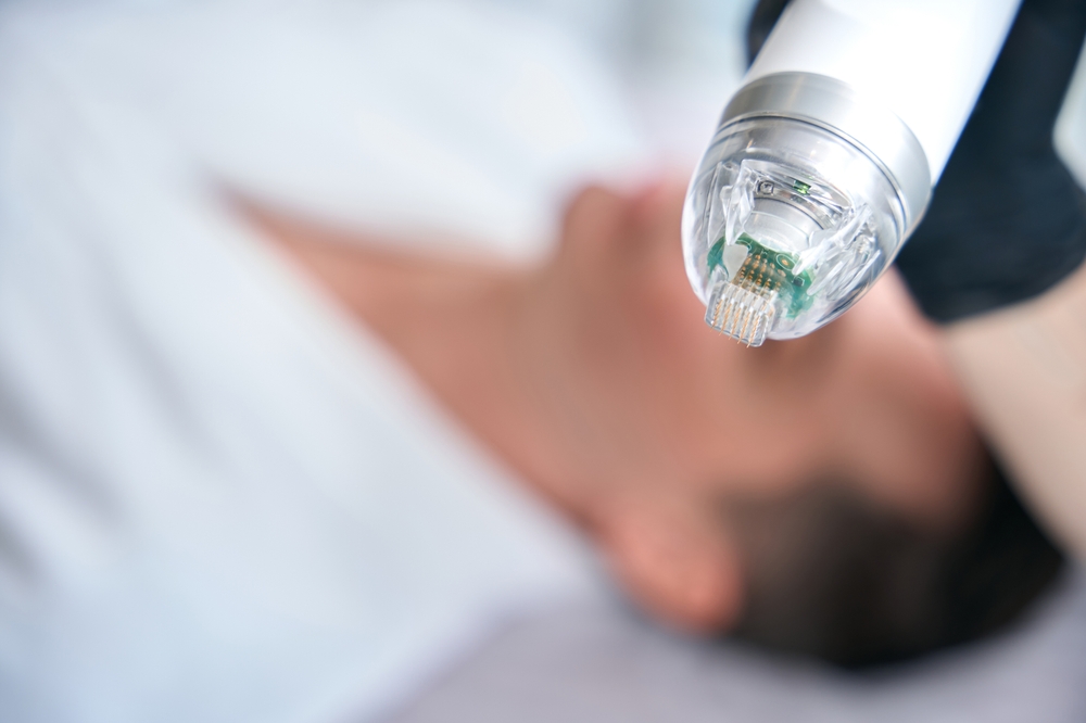 Vivace RF Microneedling