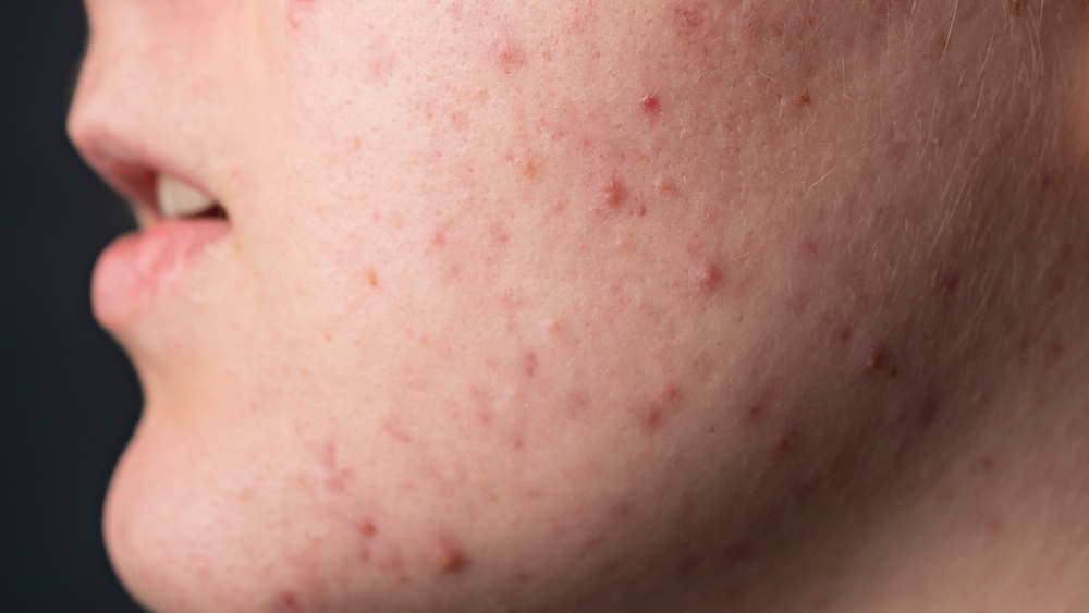 Acne behandeling bij Lavish Huidinstituut Haarlem